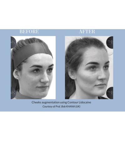 Pluryal Contour Lidocaine | بلوريال كونتور